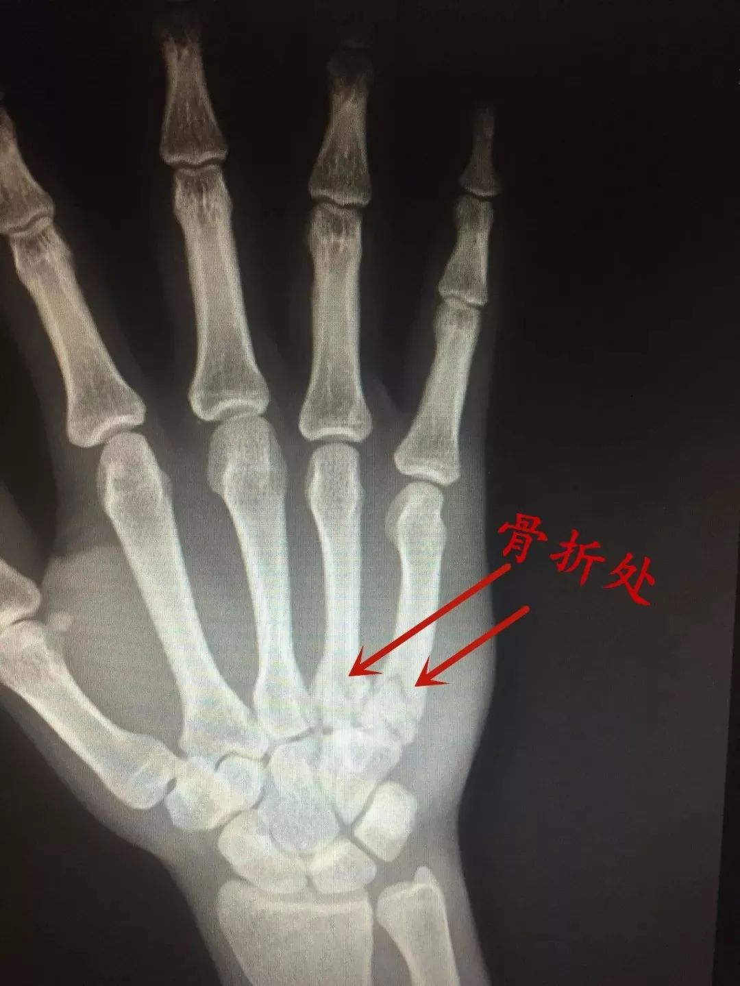 10岁男孩打拳皇致掌骨骨折,游戏与安全的边界 10岁男孩打拳皇致掌骨骨折,游戏与安全的边界